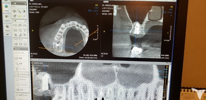 歯科用CT、マイクロ完備