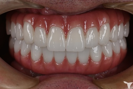 All-on-4上部構造