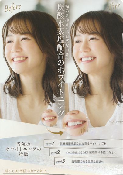 ホワイトニング