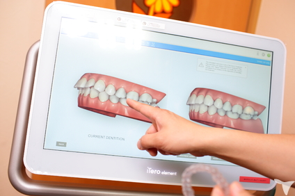インビザライン