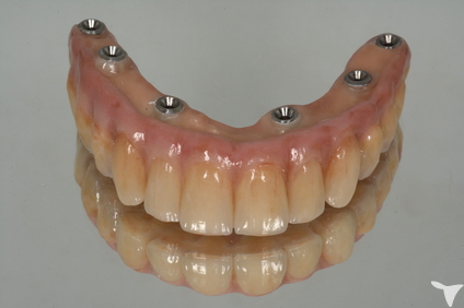 Implant