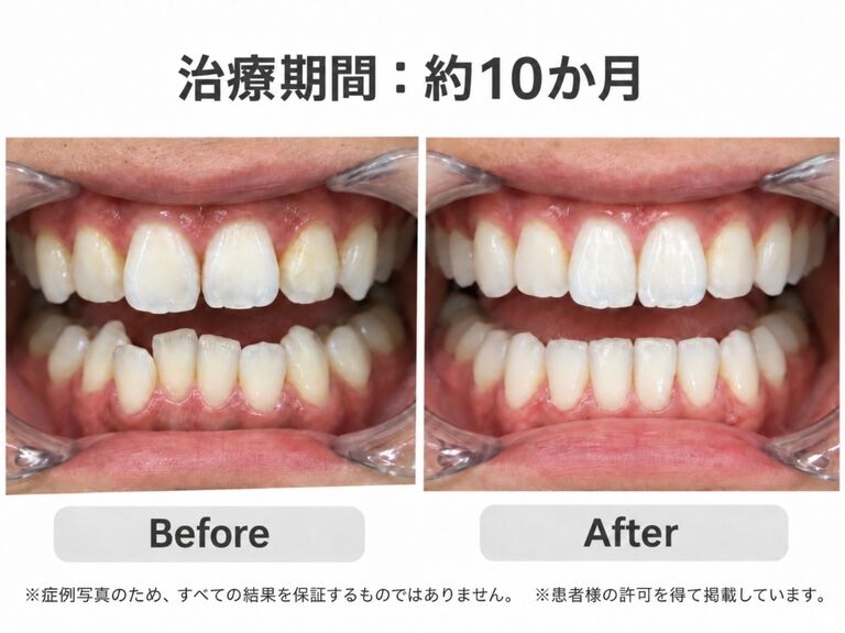マウスピース矯正