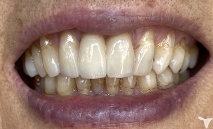 Emax　stain