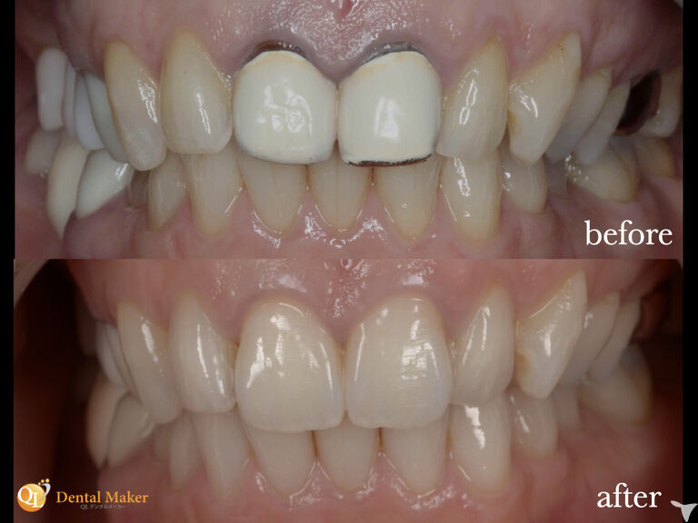 ポーセレン築盛