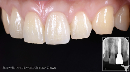 前歯部インプラント