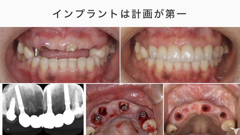 インプラントは計画が第一