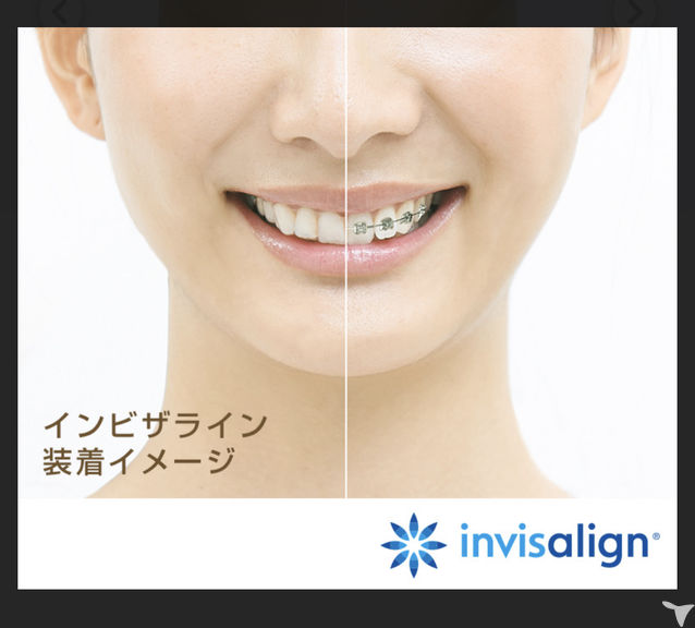 インビザライン