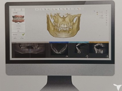 口腔内スキャナーあり