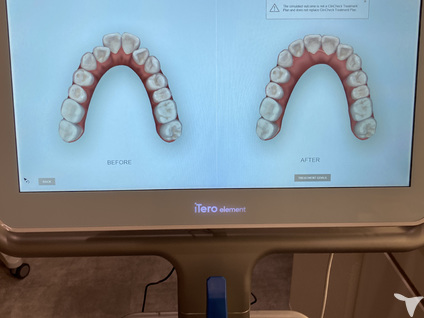 口腔内スキャンiTero