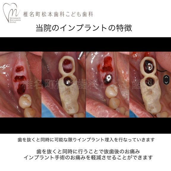 インプラント治療